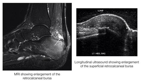 Insertional Achilles Tendinopathy - differential diagnosis and treatment by Seth O'Neill and Tom ...