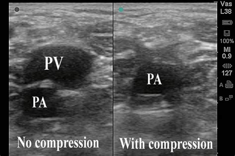 DVT Images | Emergency Ultrasonography