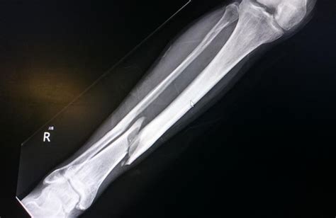 Bone fracture in x-ray. What to know about bone fracture repair | Bone fracture, Fracture ...