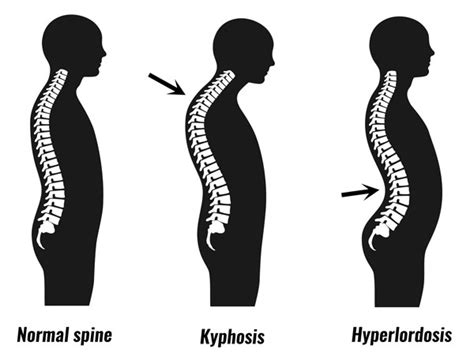 Kyphosis Caused By Poor Posture - Causes, Treatment & Exercises