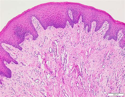 Pathology Outlines - Irritation fibroma