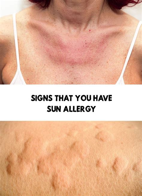 Sun allergy - Signs that you have sun allergy | Sun allergy, Allergies ...