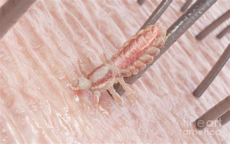 Head Louse On A Human Head Photograph by Sebastian Kaulitzki/science Photo Library | Fine Art ...