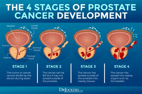 Prostate Cancer: Symptoms, Causes and Support Strategies