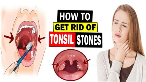 How to Get Rid of Tonsil Stones Naturally || Home Remedies for Tonsil Stones Treatment - YouTube