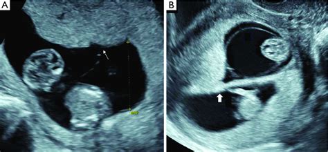 First trimester ultrasound appearance of a monochorionic and... | Download Scientific Diagram