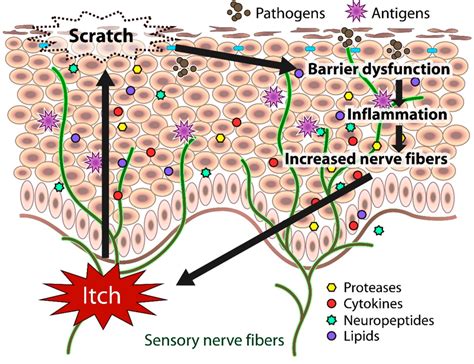 Schematic representation of chronic itch in atopic dermatitis ...