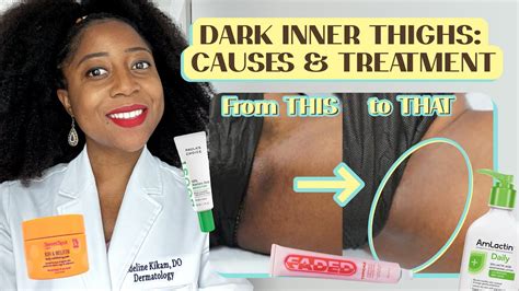 Dark Spots Inner Thighs Treatment - Infoupdate.org