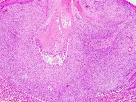 Pathology Outlines - Trichilemmoma