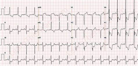 Coronary Artery Disease - STEMI Case #10 | LearntheHeart.com