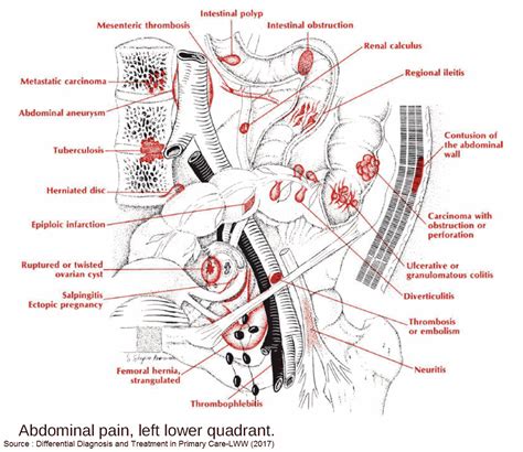 Lower Abdominal Pain in the Emergency Department - Manual of Medicine