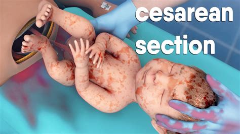 A cesarean section | known as a C-section | is a surgery to deliver a baby via the abdomen - YouTube