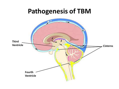 Pediatric DR-TB Meningitis: A Case-Based Discussion - YouTube