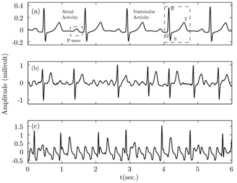 Atrial Flutter Vs Atrial Fibrillation