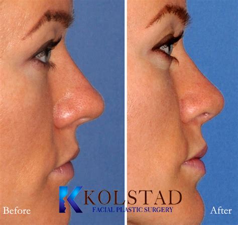 Bulbous Tip Rhinoplasty La Jolla Before & After Gallery 1 | Dr. Kolstad ...