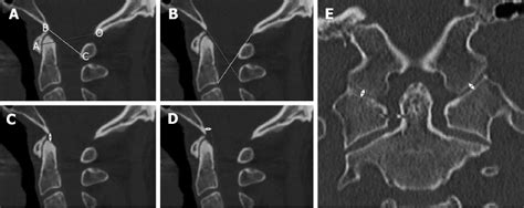 Diagnostic methods for atlanto-occipital dislocation (see text for ...