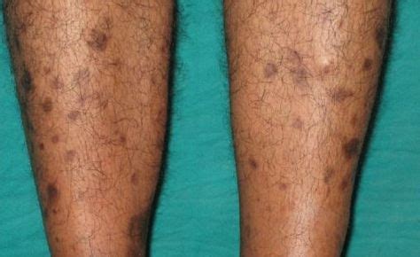 Brown Spots on Legs, Lower Legs, Get Rid of Little Light Brown Dots on Ankles, Feet and Legs ...