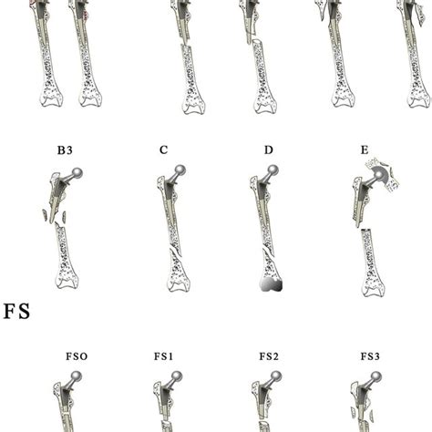 Current periprosthetic femoral fracture classifications. | Download Table