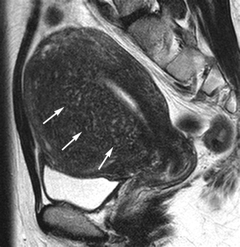 MR Imaging Findings of Adenomyosis: Correlation with Histopathologic Features and Diagnostic ...