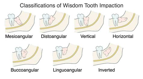 Wisdom Tooth Impaction in Ventura, CA - Pacific Oral Surgery