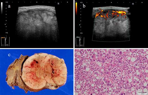 Sonographic Appearances of Liposarcoma: Correlations with Pathologic ...