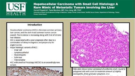 Hepatocellular Carcinoma with Small Cell Histology: A Rare Mimic of ...