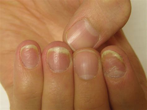 Nail Psoriasis Tips | MDedge Dermatology