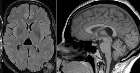 Radiology MRI: Cavum Velum Interpositum on MRI