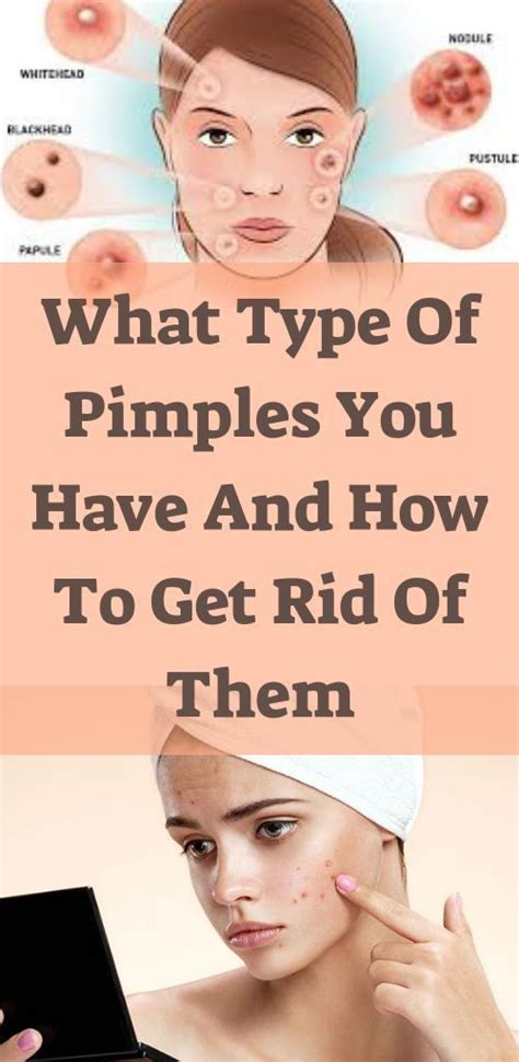 WHAT TYPE OF PIMPLES YOU HAVE AND HOW TO GET RID OF THEM