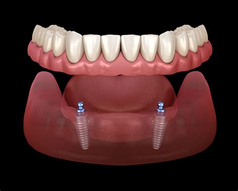 Removable Dentures - Nova Denture Center | Coquitlam & Lower Mainland