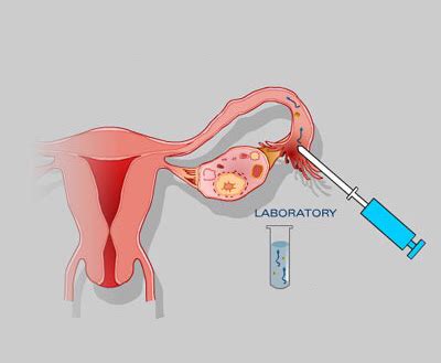 Gamete Intra-Fallopian Transfer (GIFT) - Isfahan Fertility and Infertility Center