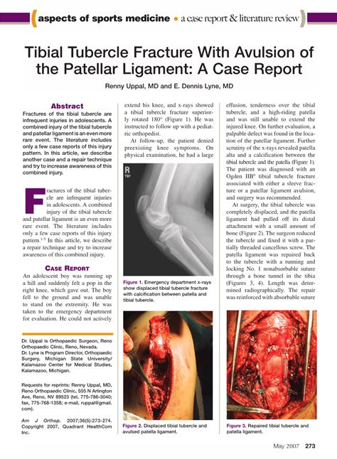 Tibial Tubercle Fracture with Avulsion of the Patellar Ligament: a Case Report Renny Uppal, MD ...