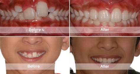 Before and After | Viva Orthodontics