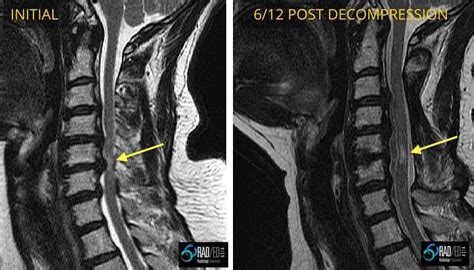 Spondylotic Myelopathy vs Myelomalacia: No more confusion | Radedasia