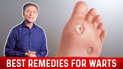 4 Best Wart Removal Remedies – Dr. Berg on Wart Treatment at Home - YouTube