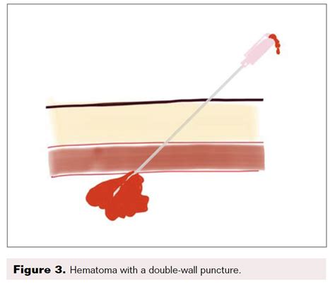 Traditional Seldinger Technique | Vascular Disease Management