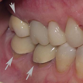 Zirconia Crowns Vs Porcelain