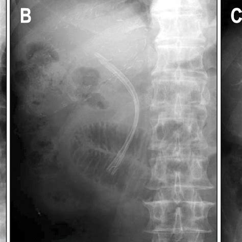 A case of anastomotic stricture in a living donor liver... | Download Scientific Diagram