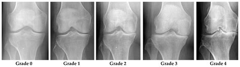 Diagnostics | Free Full-Text | Identifying Severity Grading of Knee Osteoarthritis from X-ray ...