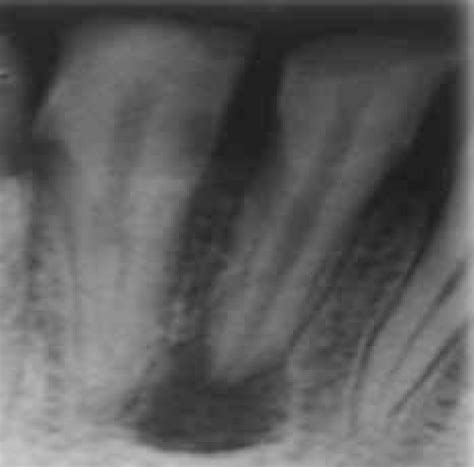 Preoperative intraoral periapical radiograph. | Download Scientific Diagram