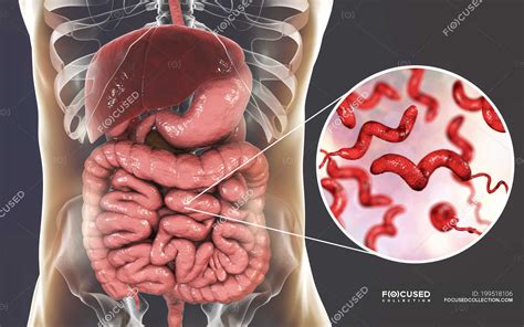 Intestino humano y primer plano de la bacteria Campylobacter jejuni causante de ...