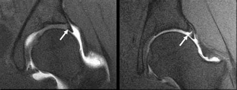 MRI and Hip Labral Tear - Robert Howells