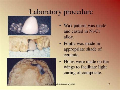 Resin bonded bridges.modi /certified fixed orthodontic courses by Ind…