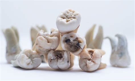 Rotten Teeth: Symptoms, Causes and Treatments