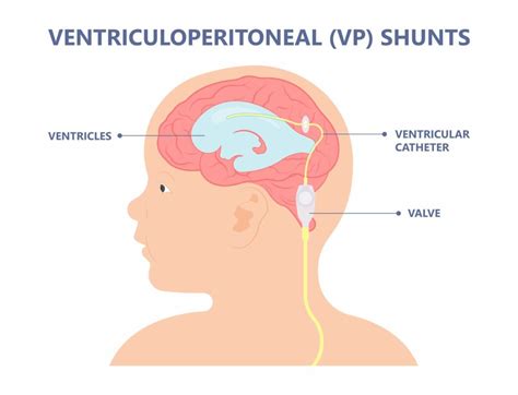 Ventriculoperitoneal Shunt - Hart Garner, MD