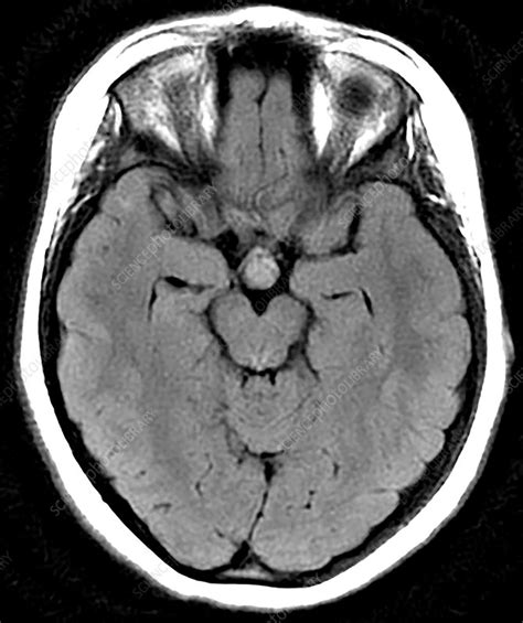 Hypothalamic Hamartoma, MRI - Stock Image - C030/6377 - Science Photo ...