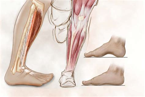 How to Manage Shin Splints - Hughston Clinic