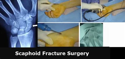 Scaphoid Bone Fracture Surgery