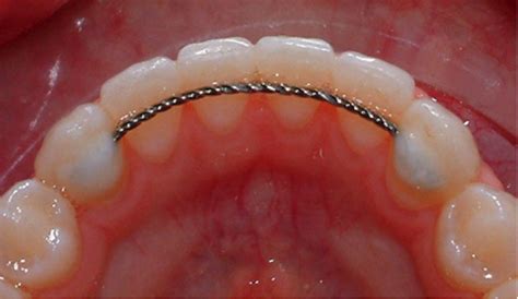 Retainer Instructions - Orthodontics Appliances - Garden City Orthodontist Dr. Denise Emma, DDS