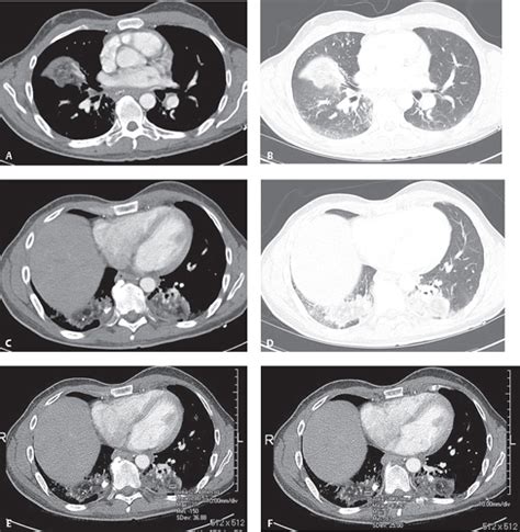 113 Exogenous Lipoid Pneumonia | Radiology Key